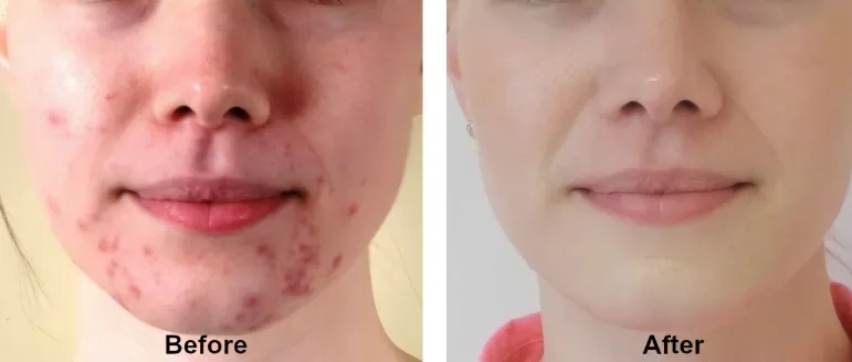 fusidic acid powder fusidic acid powder