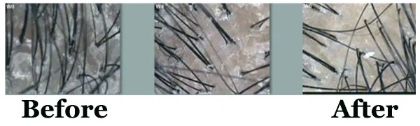 Hexamidine Diisethionate Hexamidine Diisethionate